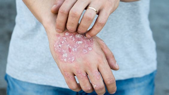 Atopic Dermatitis (Eczema) Feature Image