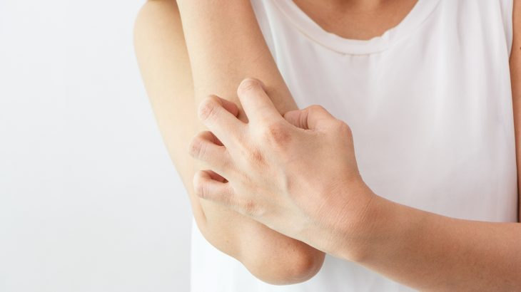 Tips For Managing Eczema Flares in Winter Feature Image